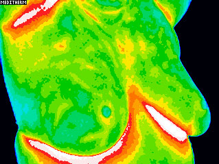 Sample-ACCT-Thermography Breast Image